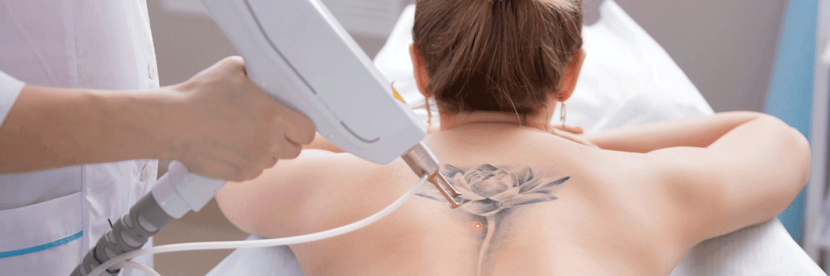 Tattoo Removal By Laser