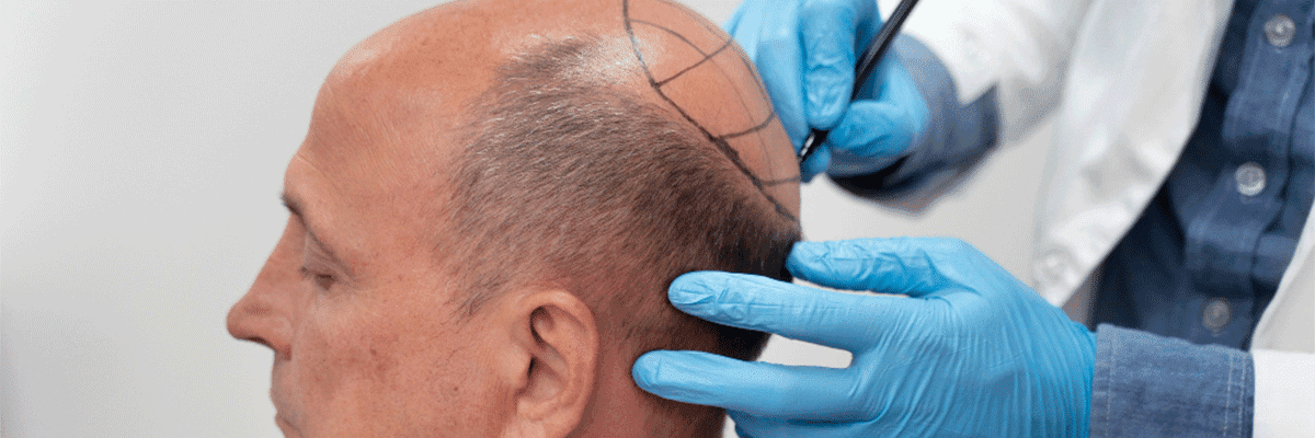 Hair Transplant
